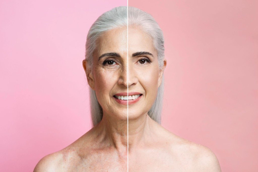 Under Eye Fillers