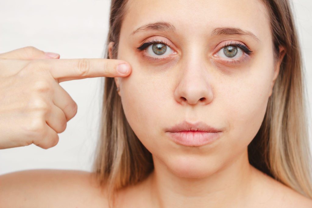 Under Eye Fillers